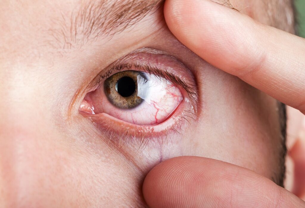 Common Eye Disorders