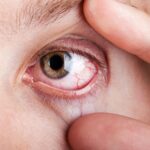 Insights Into Eye Health: Common Eye Disorders