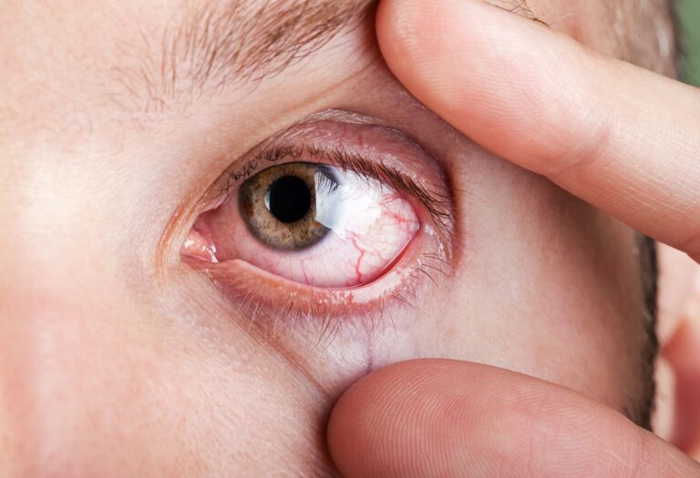 Common Eye Disorders